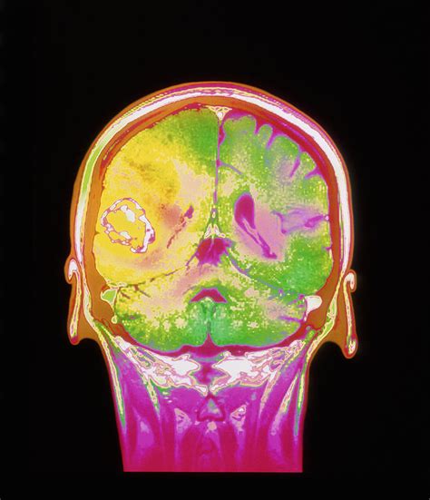 Coloured Mri Scan Of A Metastatic Brain Tumour Photograph By Simon