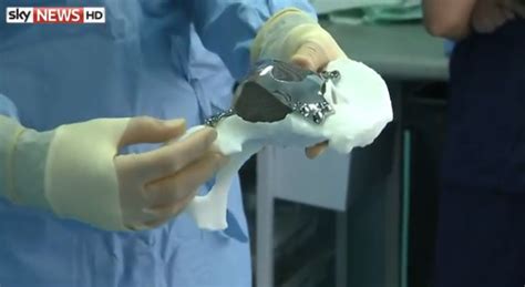 3d Printed Hip Implant Puts 71 Year Old Woman Back On Her Feet Hip Implants Old Women Woman Back