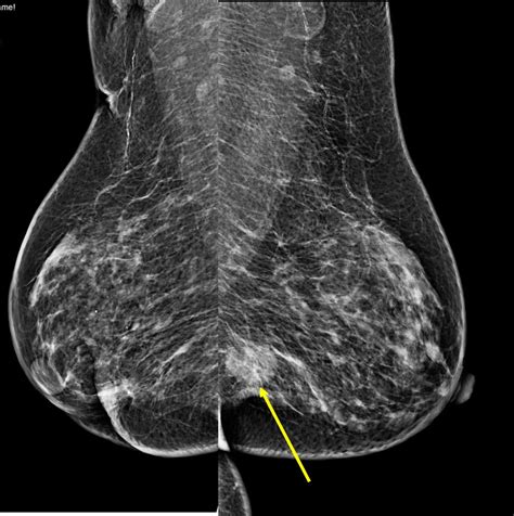 Metachronous Breast Cancer Radiology Cases