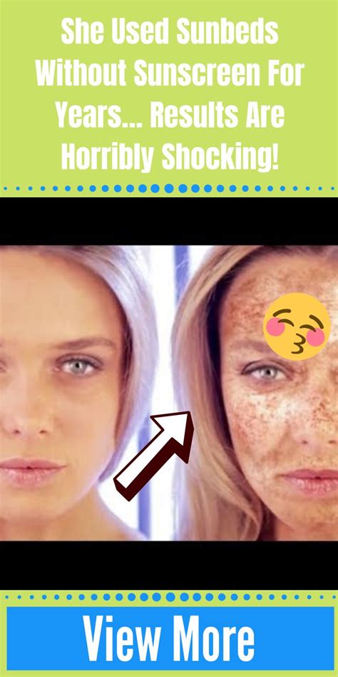 She Used Sunbeds Without Sunscreen For Years… Results Are Horribly