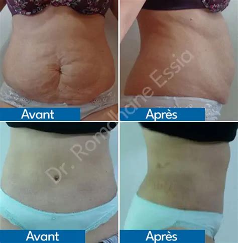 Abdominoplastie Tunisie Chirurgie Ventre Plat Tunisie Prix