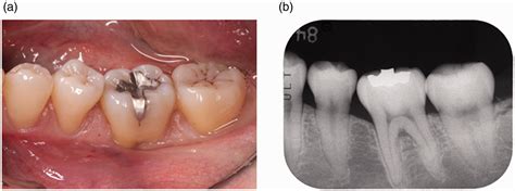 Two Stage Approach For Class Ii Mandibular Furcation Defect With