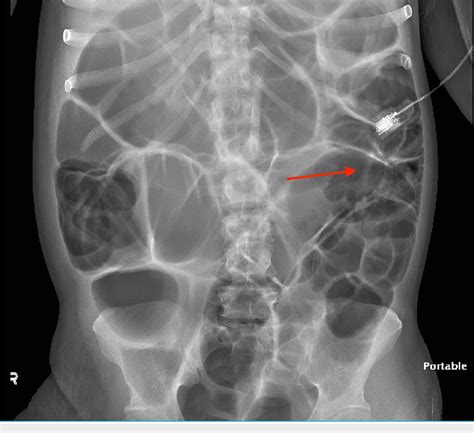 Pdf A Case Of Stercoral Colitis Complicated By Ischemic Colitis In A Young Patient Semantic