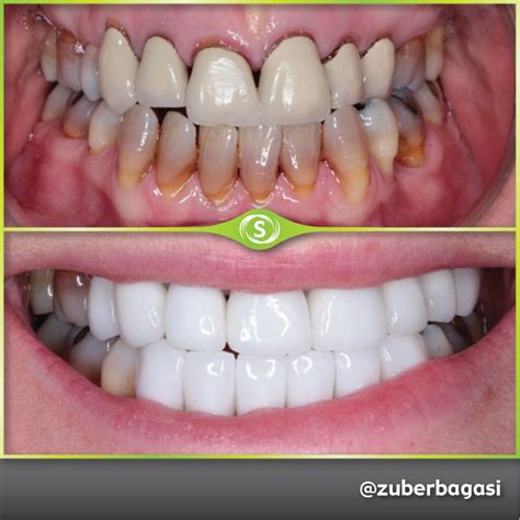 Zirconia Crowns Dr Zuber Bagasi Synergy Dental Clinic