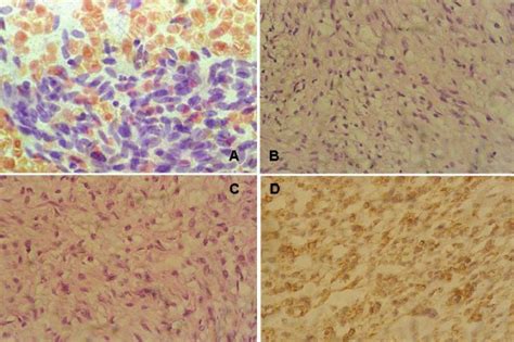 Spindle Cell Lipoma A Benign Cytology Bsct Moderately Cellular