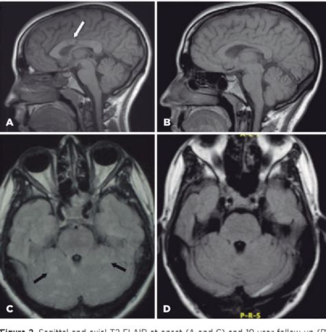 Susac S Syndrome Isolated Retinal Artery Occlusion After Years Of