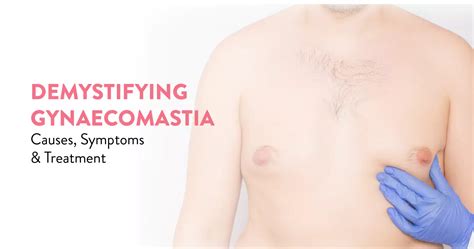 Demystifying Gynaecomastia Causes Symptoms And Treatment Ck Birla Hospital