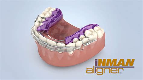 Inman Aligner - Kingston Dental Galway - Tel: 091 525 797