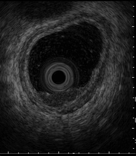 Mhz Miniprobe Endoscopic Ultrasound Showing A Hypoechoic Mm