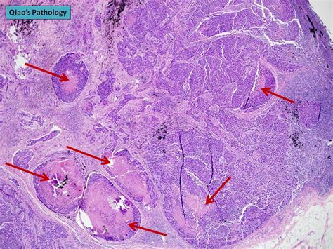 Invasive Ductal Carcinoma Histology