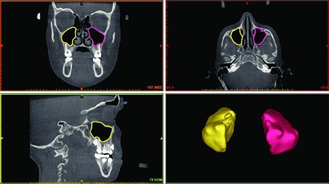 Three-dimensional reconstruction of the maxillary sinuses. | Download ...