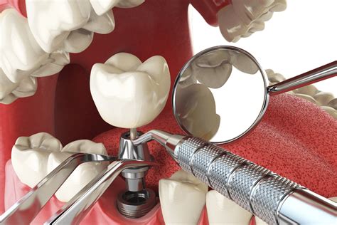 How Much Do Dental Implants Cost In Australia