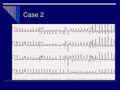 Ppt Ekg Conduction Abnormalities Part I Powerpoint Presentation Free
