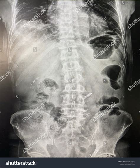 Perforated hollow viscus : 8 images, photos et images vectorielles de