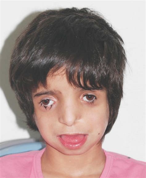 Treacher Collins Syndrome Causes Signs Symptoms Diagnosis Treatment