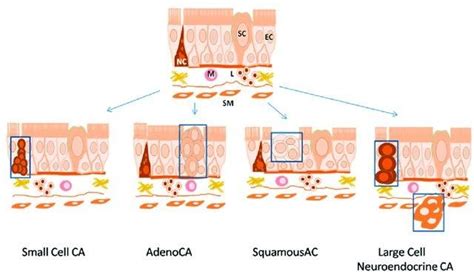 Histological Types Of Lung Cancer 34 Download Scientific Diagram