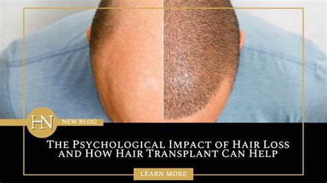 4 Hair Transplant Myths Debunked Hairnation