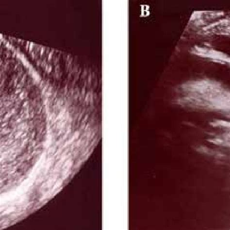 Pdf Predictive Value Of Cervical Length Measurement By Transvaginal