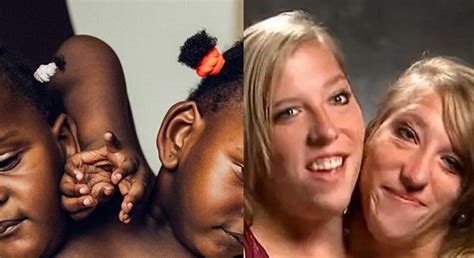 10 Things To Know About Conjoined Twins Nigerias Fast Growing Online