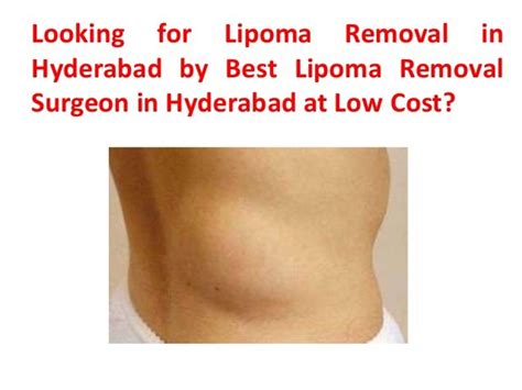 Lipoma Removal Cost In Hyderabad Lipoma Doctor In Hyderabad