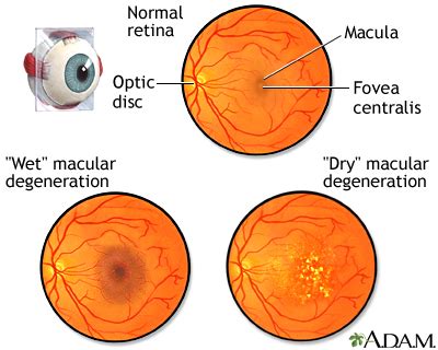 Wet Amd Vision