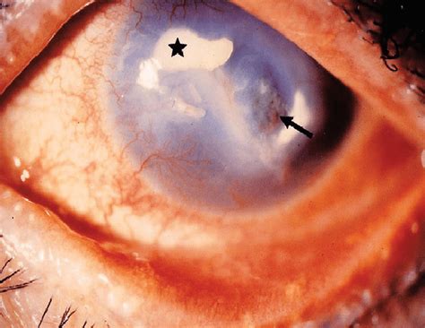 The Inflamed Left Eye Shows Severe Meibomitis Calcium Deposits Star