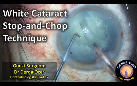 Guest Surgeon White Cataract Stop And Chop Cataract Coach™