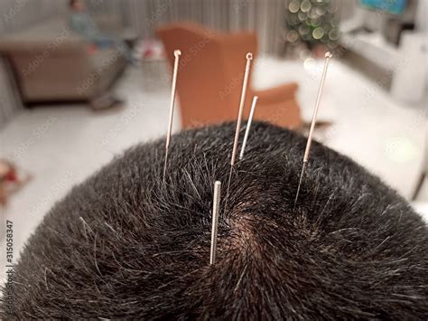 Chinese Acupuncture Needles