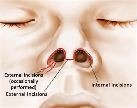 RBCP - Alar cartilage flap for projection of the nasal tip