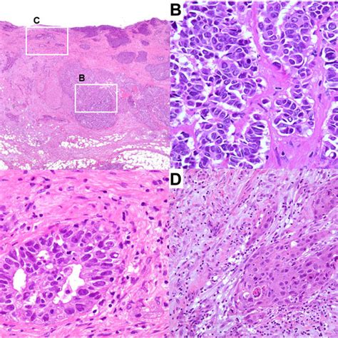 Microscopic Findings Of The Resected Specimen With Hematoxylin Eosin