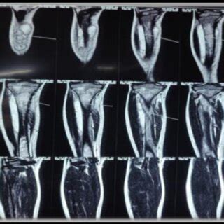 MRI suggesting sub-periosteal abscess in lateral aspect of proximal ...