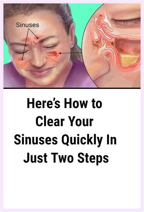 Heres How To Clear Your Sinuses Quickly In Just Two Steps Sinusitis