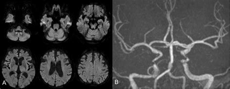 Figure 1 From Spontaneous Cervical Epidural Hematoma Treated With Rt Pa