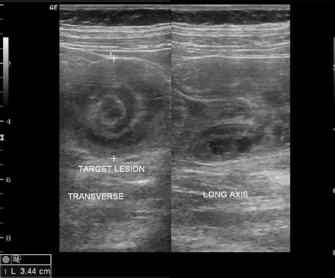 Intussusception Ultrasound Protocol