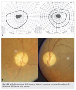 Neuro Ophthalmology Illustrated Chapter 8 Optic Neuropathies 10