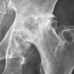 Hip Osteoarthritis Physiopedia