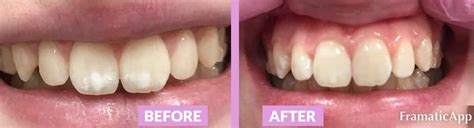 Fluorosis Treatment Using Icon Infiltration Step By Step