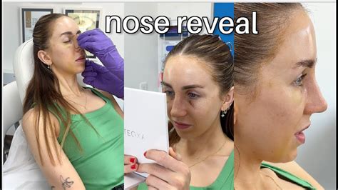 Seeing My NEW NOSE For The First Time Getting My Cast Off