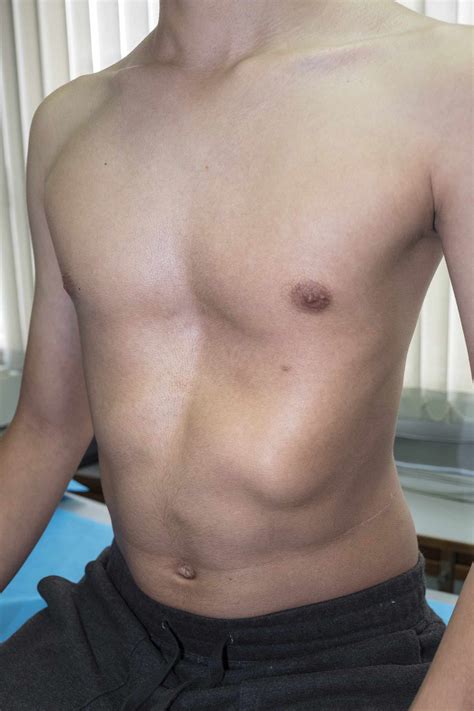 Pectus Excavatum Surgery Preparation And Recovery