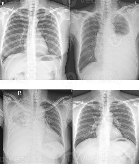 Collection Chest X Ray For Doctors And Medical Professionals To Learn