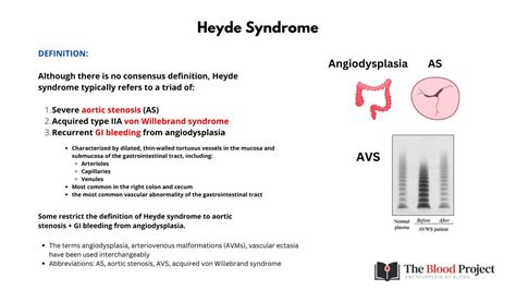 William Aird On Twitter Did You Know That Heyde Syndrome Which