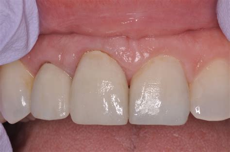 Laser Gingivectomy West Lebanon Nh