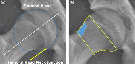 Sclerotic Lesions Of The Femoral Headneck Junction For Diagnosis Of