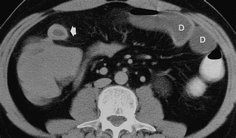 Ct Evaluation Of Small Bowel Obstruction Radiographics