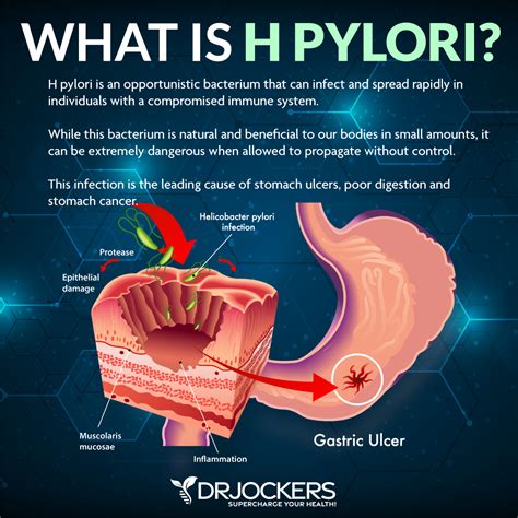 H Pylori Protocol: Diet & Herbal Strategies - DrJockers.com