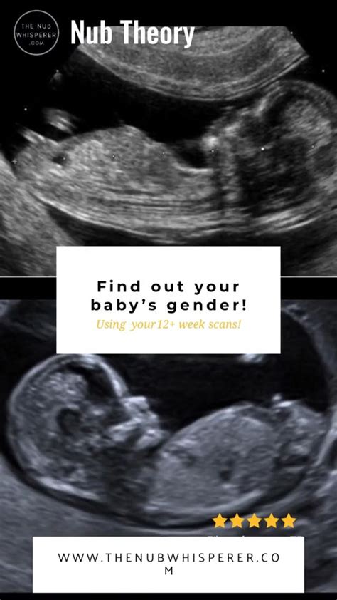 12 Week Ultrasound Pictures Gender