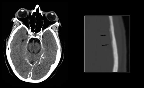 Ct And Mr Imaging Of Progressive Dural Involvement By Nephrogenic Systemic Fibrosis American