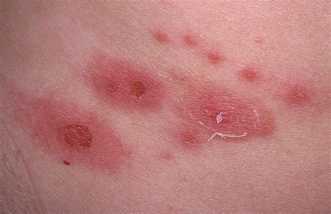 Shingles Picture Hardin Md Super Site Sample