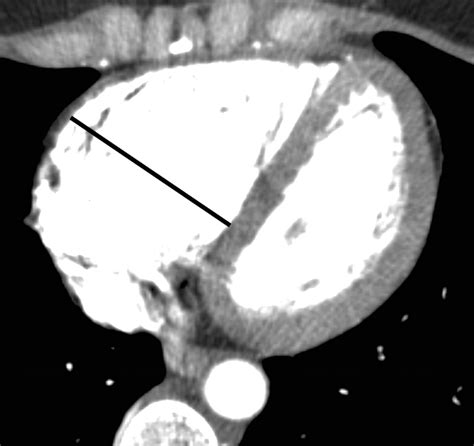 How I Do It Ct Pulmonary Angiography Ajr