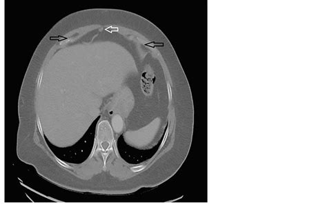 Computed Tomography Of The Abdomen Showed Fat Containing Umbilical